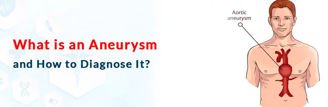 What is an Aneurysm and How to Diagnose It?